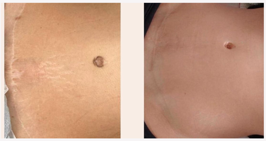 Nanoestrias — método Tabata Maffini